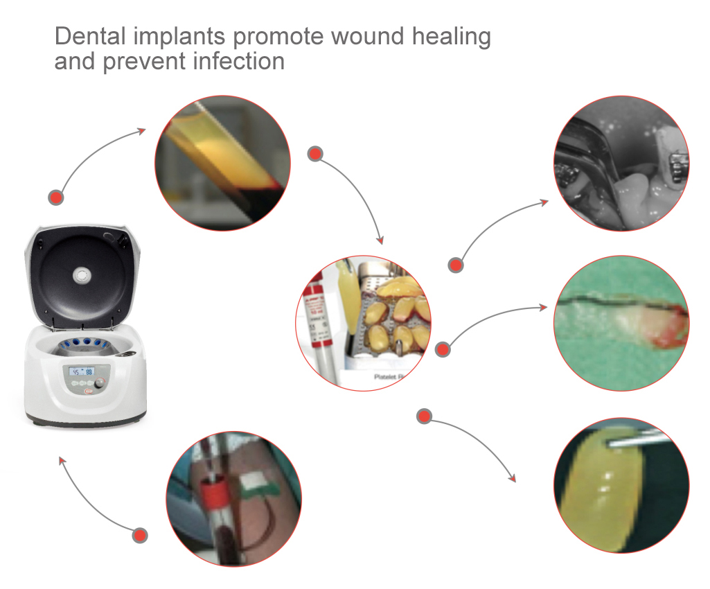 NADE DM0412P medical beauty low-speed Centrifuge LCD display 300-4500rpm for orthopedic, aesthetic surgery,oral surgery, etc.